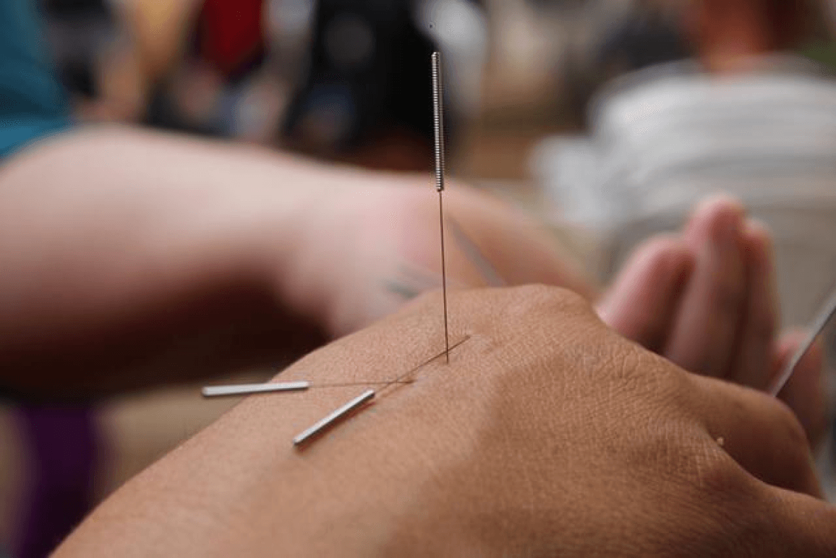 Image for Acupuncture (TCM)